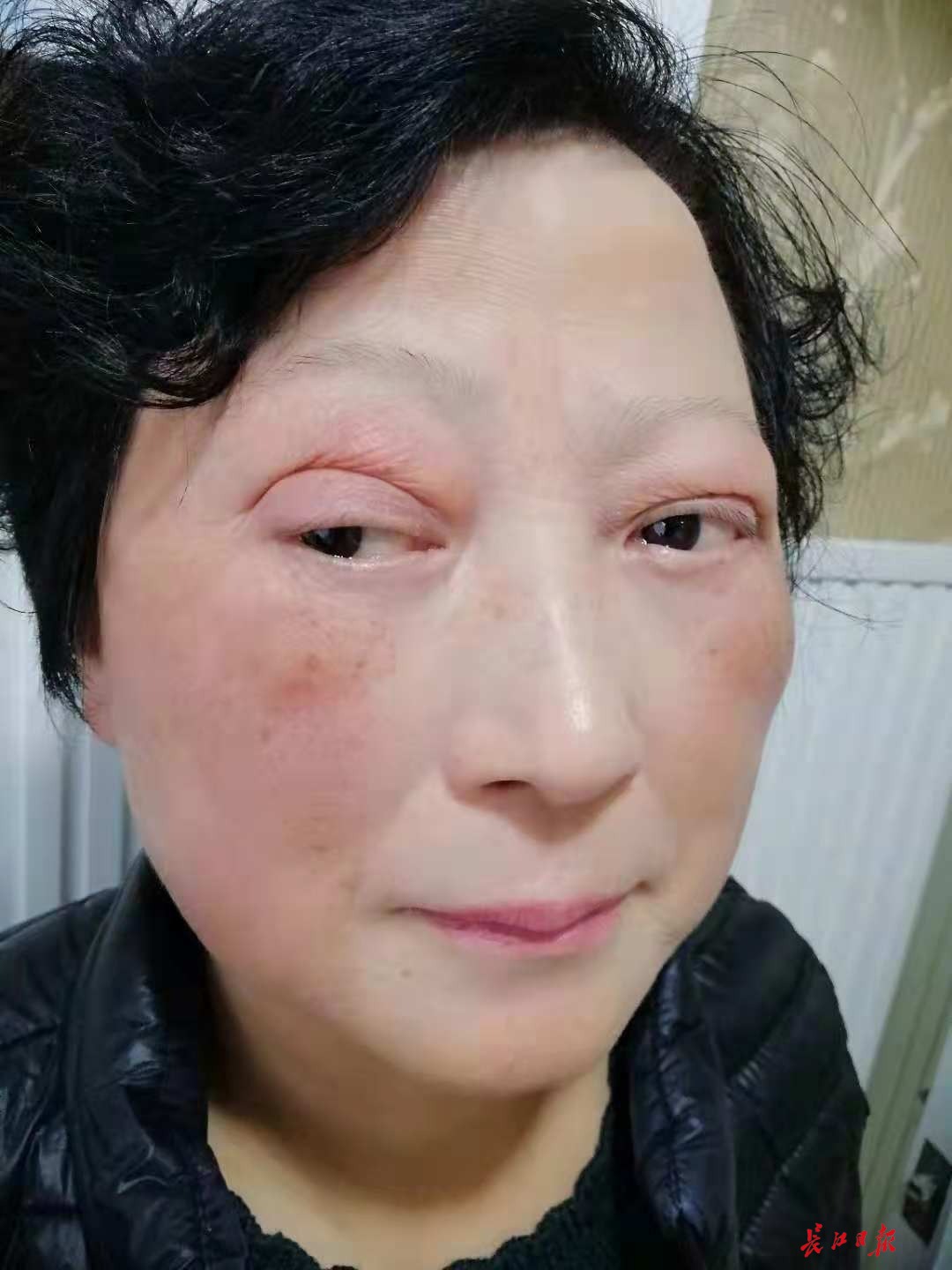 21年前割坏双眼皮21年后鼓起勇气修复揭开纱布她笑了……