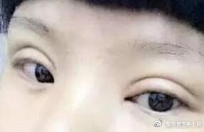 整形医生是如何把双眼皮设计好看的？