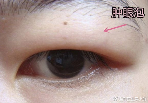 整形医生是如何把双眼皮设计好看的？