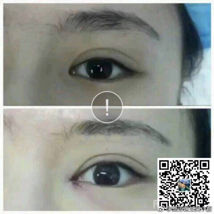 整形医生是如何把双眼皮设计好看的？