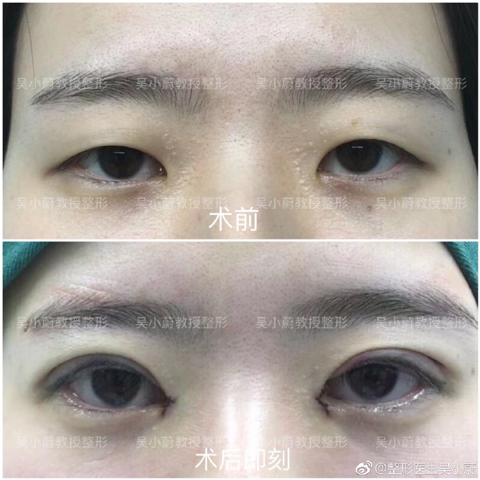 整形医生是如何把双眼皮设计好看的？