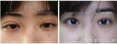 整形医生是如何把双眼皮设计好看的？