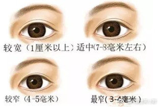 整形医生是如何把双眼皮设计好看的？