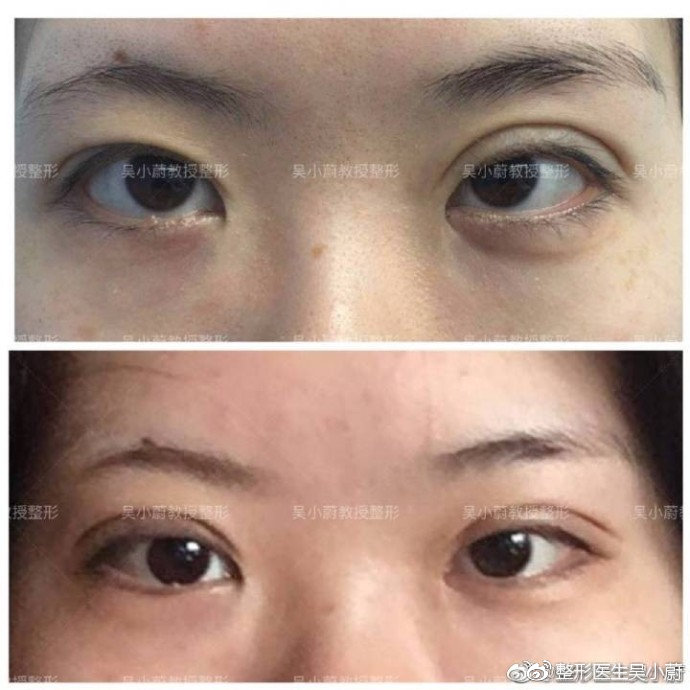 整形医生是如何把双眼皮设计好看的？