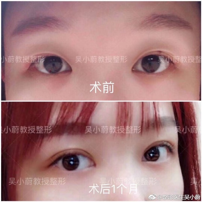 整形医生是如何把双眼皮设计好看的？