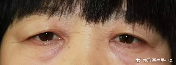 整形医生是如何把双眼皮设计好看的？