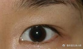 整形医生是如何把双眼皮设计好看的？