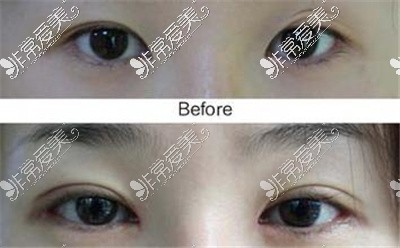 武汉哪里做双眼皮做得好？分享十家双眼皮口碑好的医院
