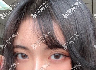 武汉哪里做双眼皮做得好？分享十家双眼皮口碑好的医院