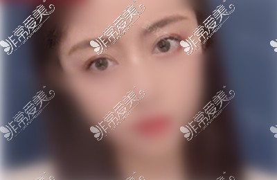 武汉哪里做双眼皮做得好？分享十家双眼皮口碑好的医院