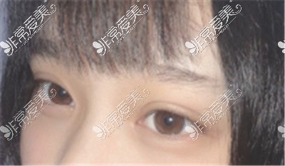 武汉哪里做双眼皮做得好？分享十家双眼皮口碑好的医院