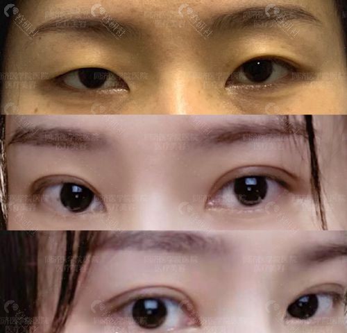 谁找武汉同济医院陈平拉过双眼皮？效果好不好看对比照了解 - 爱美容研社