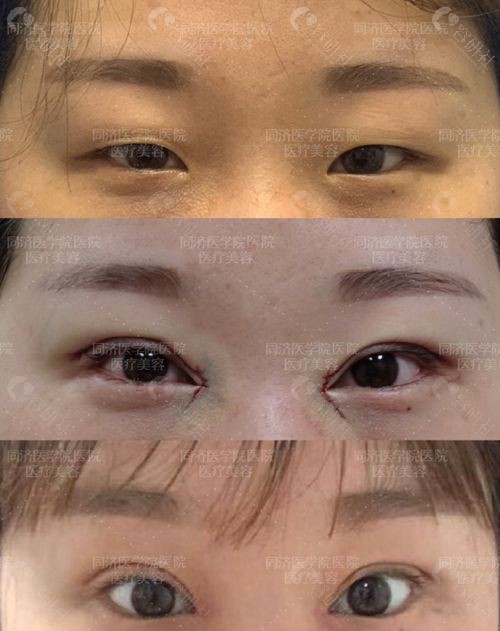 谁找武汉同济医院陈平拉过双眼皮？效果好不好看对比照了解 - 爱美容研社
