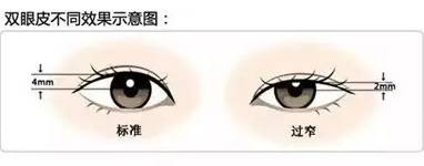 云南铜雀台美容医院左万昌主任靠谱吗 双眼皮手术失败的原因 - 钢市纵横 ：： 新
