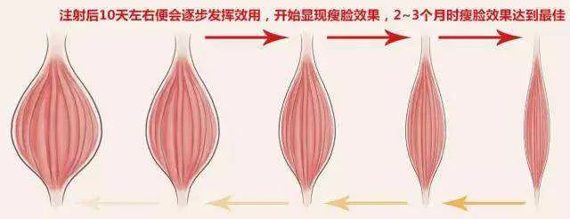 瘦脸针人人都可以打吗