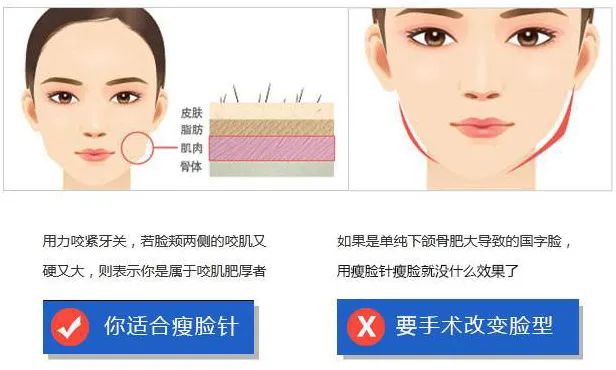 瘦脸针人人都可以打吗