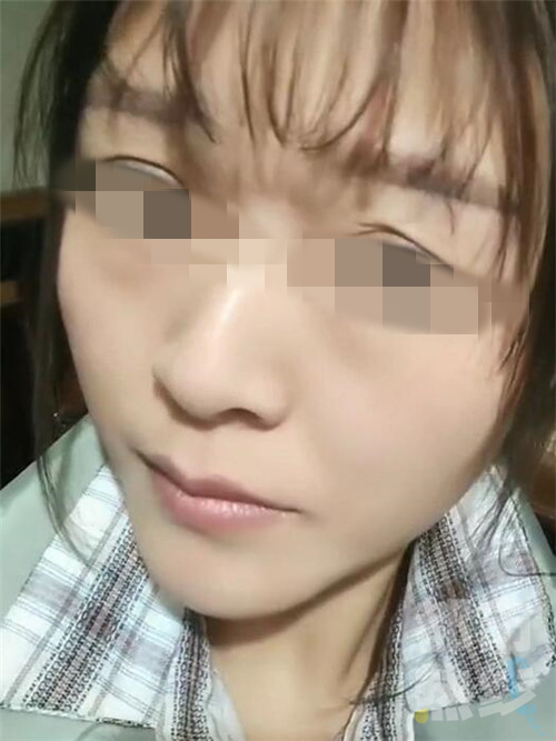 西安一女子割双眼皮割成了三眼皮 医院竟然怪患者眼皮松！