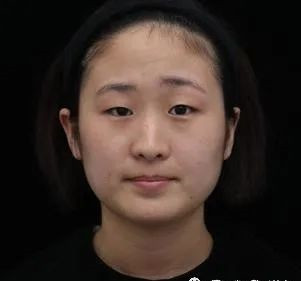 武汉同济医学院陈平医生精切双眼皮手术案例