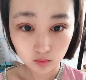 武汉同济医学院陈平医生精切双眼皮手术案例