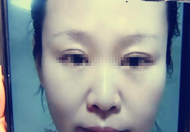 女子借钱做脸部美容手术后没效果美容院：不可能有仙女的效果