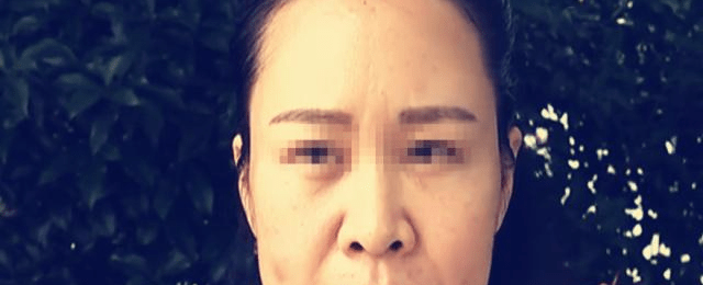 女子借钱做脸部美容手术后没效果美容院：不可能有仙女的效果