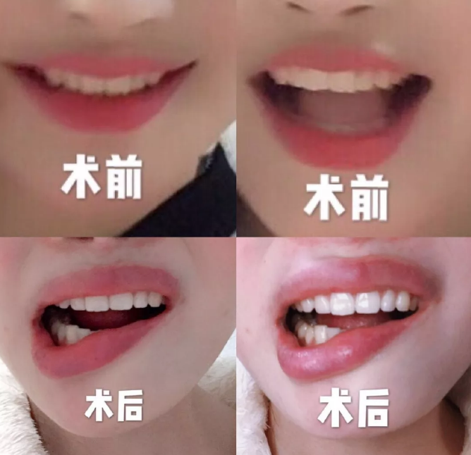 武汉华美整形手术效果怎么样？女子整容变歪嘴十级伤残恐无法修复