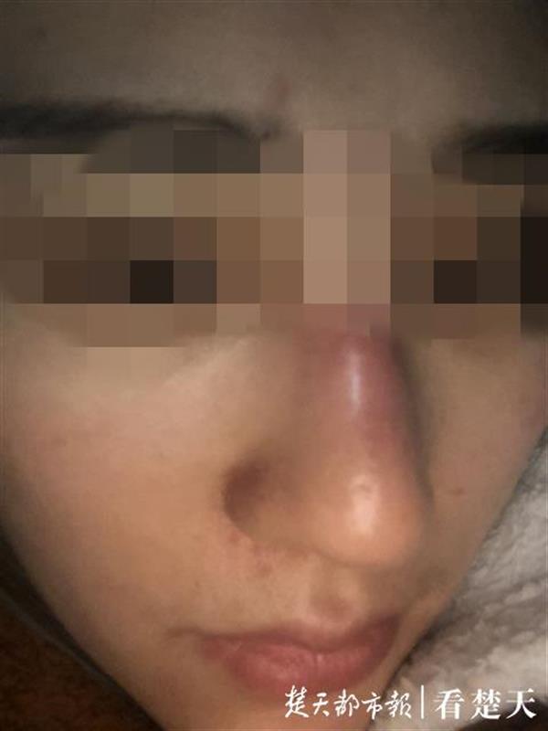 武汉“吉美拉”整形！女子花5万元变美却成这样