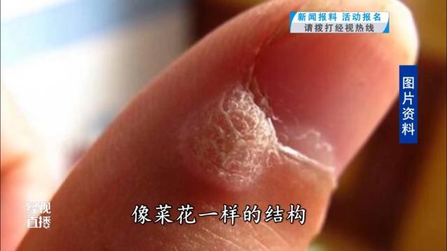 武汉一女子频繁感染HPV医生提醒：尽量避免做这种美容操作
