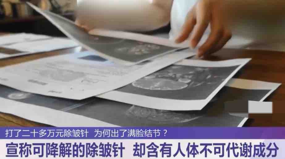 20多万针剂打坏一张脸南京连天美医疗美容药品来源成迷